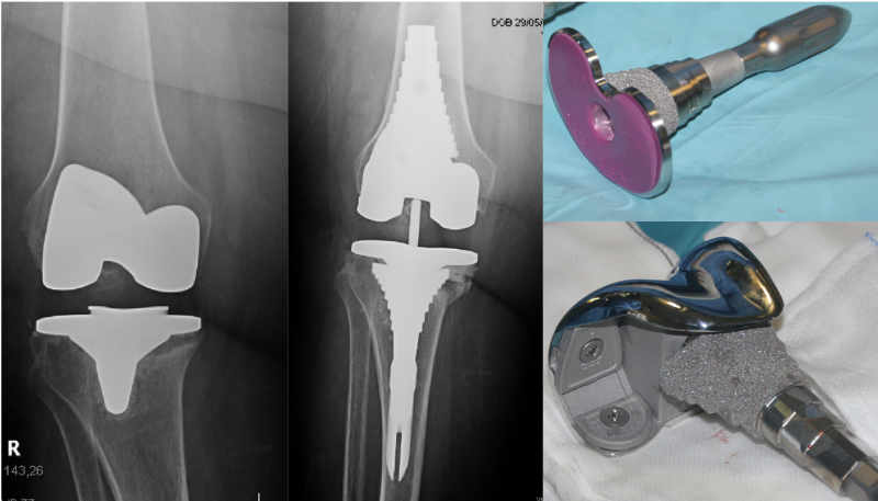 cirugía de revisión de prótesis de rodilla