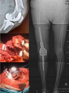 cirugía de revisión de prótesis de rodilla por fractura periprotésica