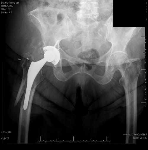 diagnóstico de la fractura periprotésica de cadera es evidentemente clínico, ya que, tras una caída, el paciente sufre un dolor súbito en la cadera donde tiene la prótesis