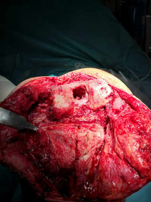 Desbridamiento radical realizado en paciente con infección protésica de rodilla con fracaso previo de un recambio en dos tiempos
