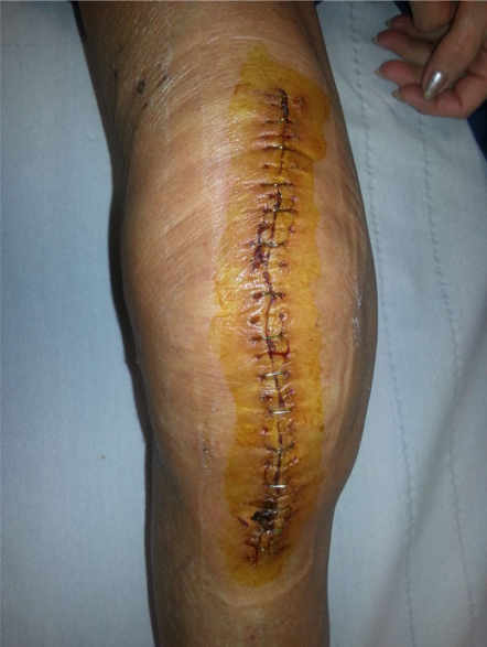 Importante derrame articular a los 7 días de la intervención, siendo necesario descartar infección aguda de prótesis de Rodilla