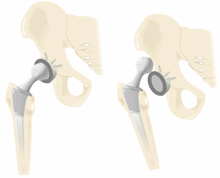 La luxación de una prótesis de cadera se produce cuando uno de los componentes de esta prótesis “se sale “de su sitio o de la articulación.