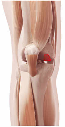 Artrosis de rodilla o gonartrosis
