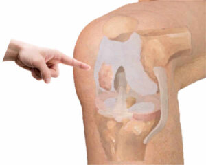 La necrosis ósea de rodilla suele debutar con un dolor brusco, incapacitante en la rodilla, que a veces va seguido con la presencia de derrame articular