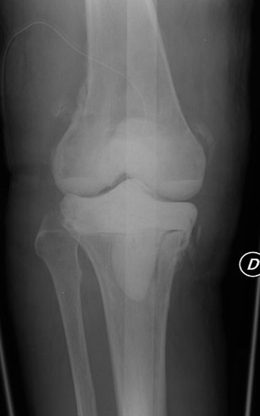 Infección de prótesis de rodilla por cándida
