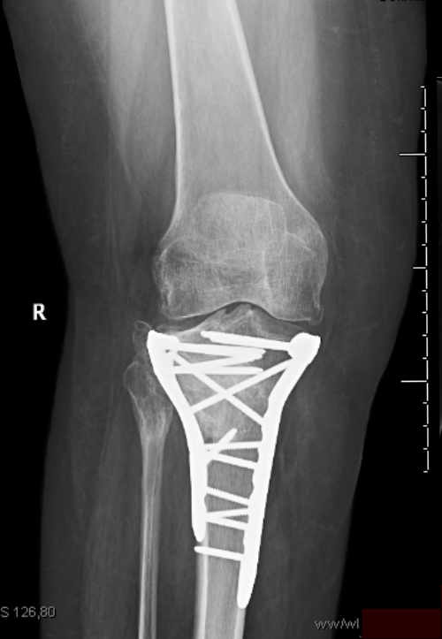 constrângerea durerii la genunchi tratamentul peisaj articular