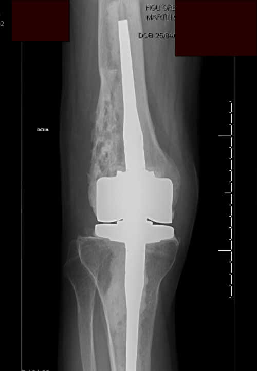Implantes protesicos de revision utlizados en el tratameinto de la artrosis postraumatica. En estos casos es encesario mejorar la fijación del implante así como la estabilidad ligamentosa