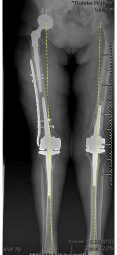 Radiografía de paciente mujer con Artrosis de rodilla o gonartrosis