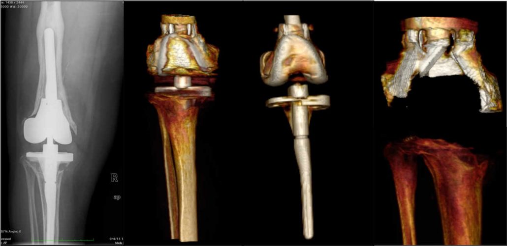 El dolor debido a la artrosis de cadera se manifiesta principalmente a nivel de la ingle, en menor medida en la zona posterior de la cadera