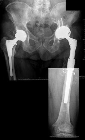 Radiografía de prótesis de cadera implantada