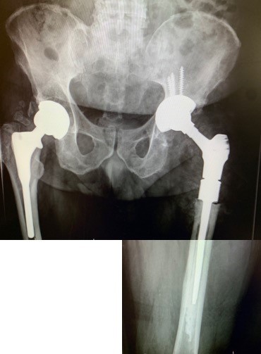 Radiografía de de prótesis de cadera infectada