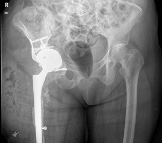 cirugía de prótesis de cadera