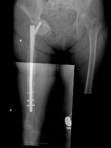radiografía protésica de prótesis de cadera del especialista Doctor Pablo Sanz