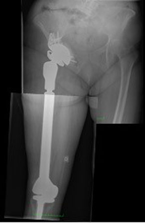 Imágenes radiológicas de una prótesis de cadera que sustituye al fémur