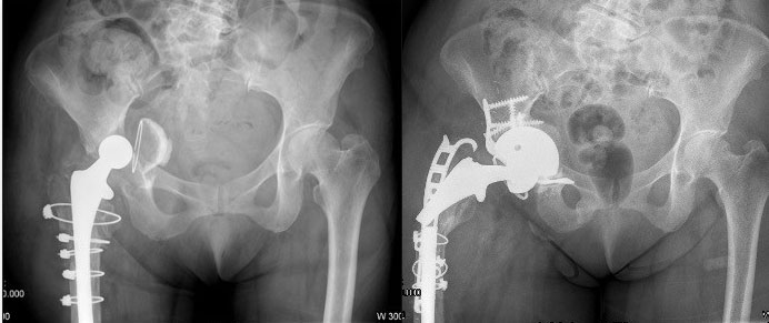 Imagen de dos de las complicaciones iniciales como son la protrusión central el cotilo (izquierda) y rotura de vástago protésico de cadera