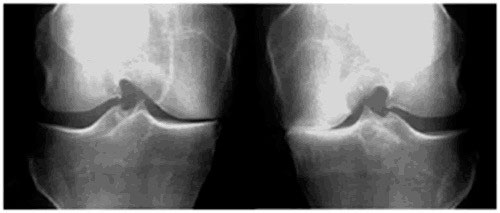 protesis-de-rodilla-artrosis-unicompartimental