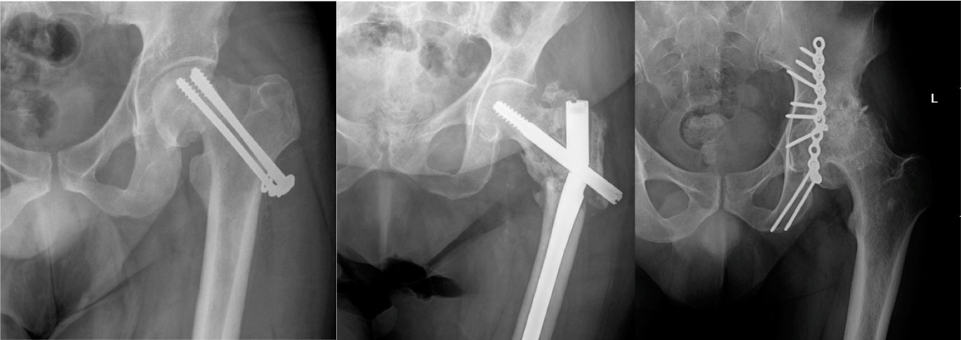 radiografía de Complicaciones tras diferentes osteosíntesis de cadera