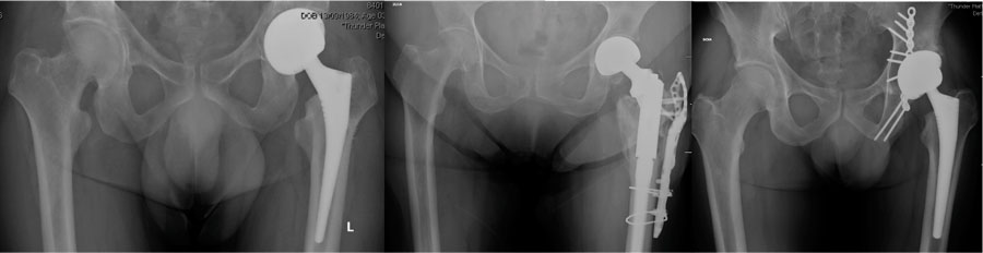 radiografía con resultado postquirúrgico tras la implantación de una prótesis de cadera en los caos anteriores.