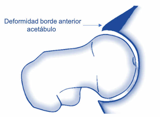 Existen tres tipos de síndrome femoroacetabular en función de su localización:  femoral, acetabular o ambos: