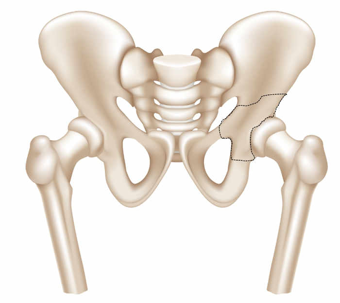 Cadera previa a osteotomía periacetabular. A zona marcada representa el fragmento de la pelvis que se va a movilizar.