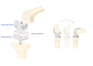 imagen de los componentes de una prótesis de rodilla