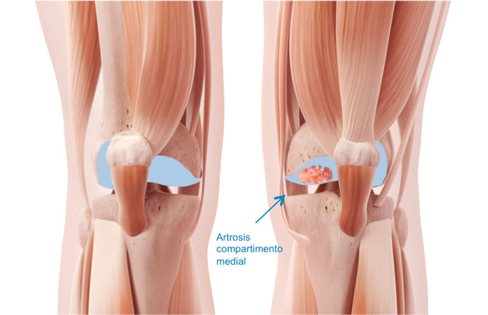 La artrosis unicompartimental de rodilla como su nombre bien indica es la degeneración de un compartimento de la rodilla, permaneciendo los otros dos restantes sanos