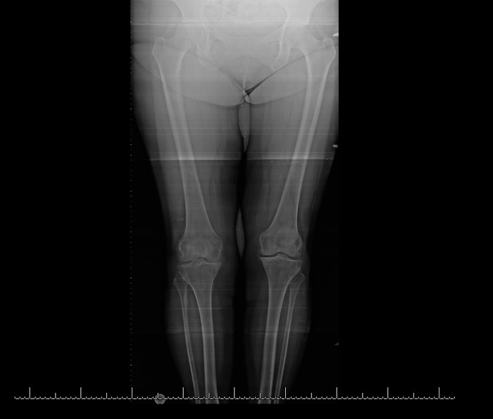 Artrosis compartimento medial rodilla drhc secundaria a meniscetomia hace 15 años