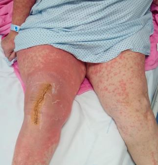 la alergia no fue a ninguno de los metales de la prótesis de cadera o rodilla, sino a uno de los antibióticos usados en el cemento para evitar la infección protésica.  