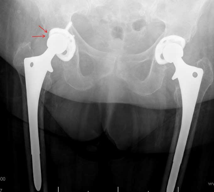 infección de prótesis de rodilla y cadera por el Doctor Pablo Sanz