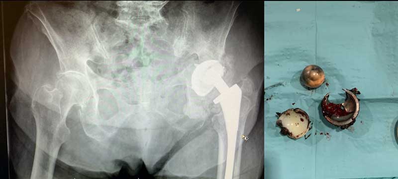 infección de prótesis de rodilla y cadera por el Doctor Pablo Sanz