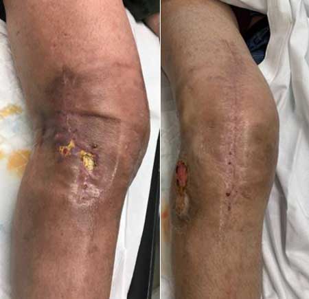 Dr. Pablo Sanz, recambio de prótesis de rodilla y cadera