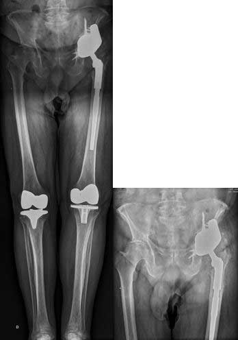 cirugía de revisión de prótesis de cadera por infección