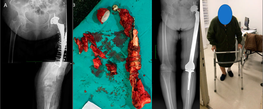 Paciente con infección intervenida de prótesis de cadera tras fracaso tratamiento fractura previa. Obsérvese la cantidad de exudado anormal a partir del 5º día postquirúrgico.